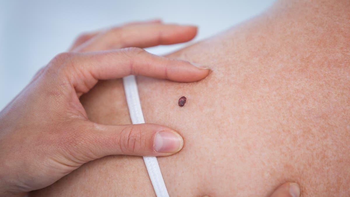Lincoln se suma a la Semana de Prevención del Cáncer de Piel